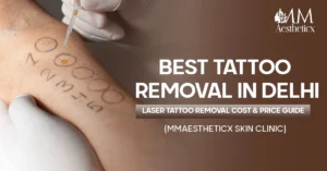 Best Tattoo Removal in Delhi