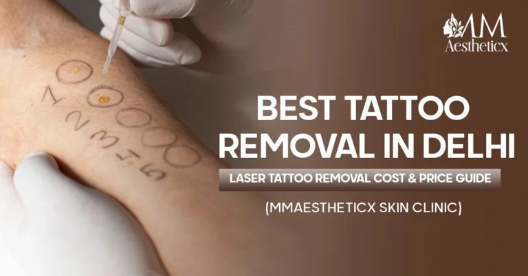 Best Tattoo Removal in Delhi